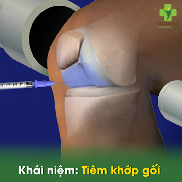 Khái niệm tiêm khớp gối