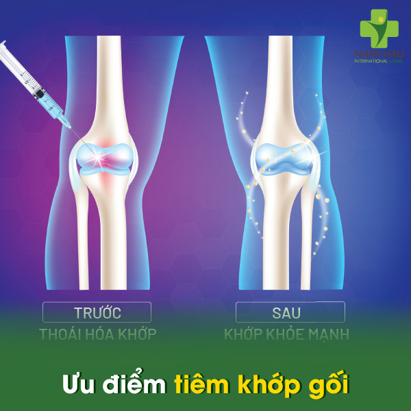 Ưu điểm tiêm khớp gối