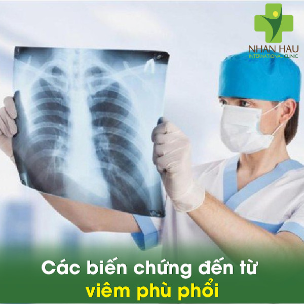 Viêm phù phổi và Các biến chứng đến từ viêm phù phổi 5 Các biến chứng đến từ viêm phù phổi