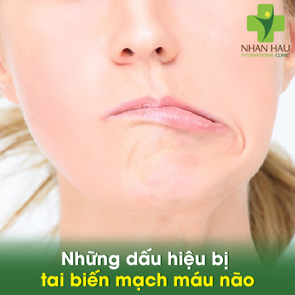 Tai biến mạch máu não nguy hiểm như thế nào 3 Những dấu hiệu bị tai biến mạch máu não