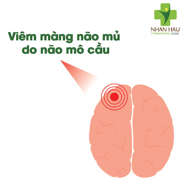 Vacxin viêm màng não mủ và căn bệnh viêm màng não mủ nguy hiểm như thế nào 1 Viêm màng não mủ là gì