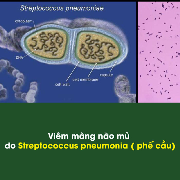 Vacxin viêm màng não mủ và căn bệnh viêm màng não mủ nguy hiểm như thế nào 3 viêm màng não mủ do Streptococcus pneumonia ( phế cầu)