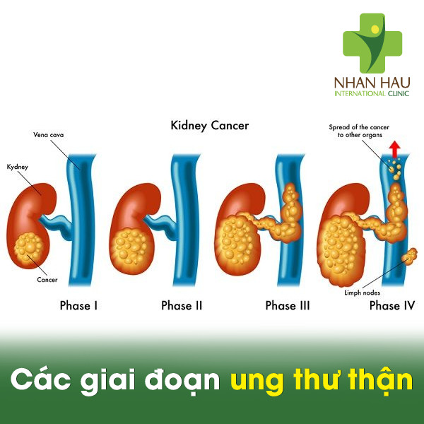Ung thư thận giai đoạn đầu có chữa được không 3 Các giai đoạn ung thư thận