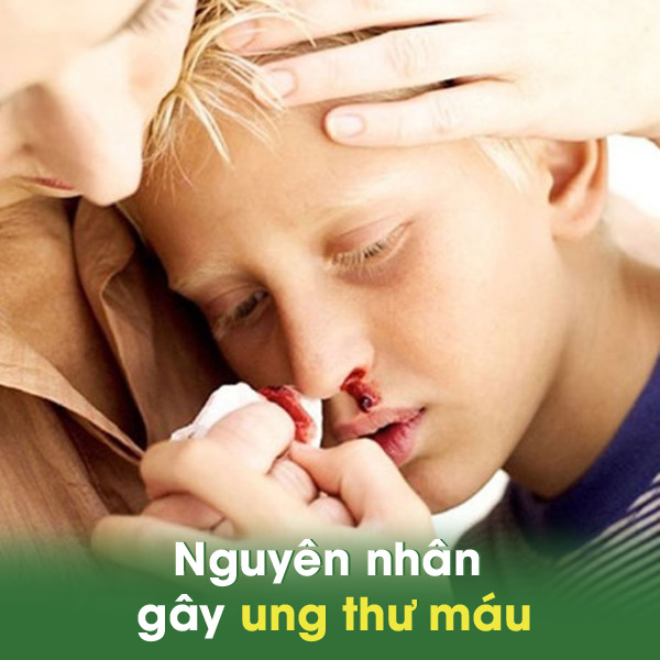 Các triệu chứng ung thư máu và những điều cần lưu ý phòng tránh 4 Nguyên nhân gây ung thư máu