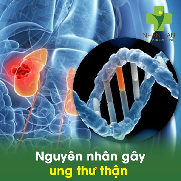 Ung thư thận giai đoạn đầu có chữa được không 4 Nguyên nhân gây ung thư thận