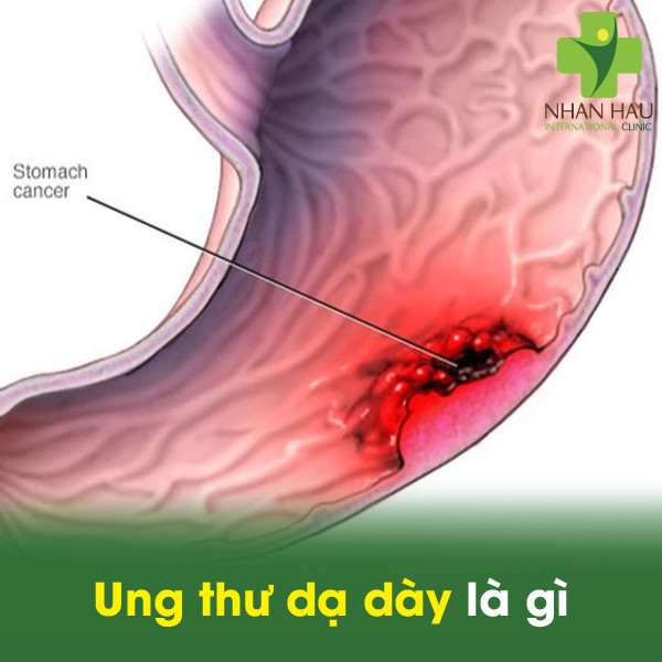Ung thư dạ dày là gì