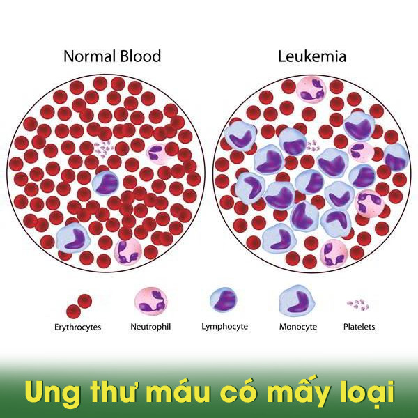 Các triệu chứng ung thư máu và những điều cần lưu ý phòng tránh 3 ung thư máu
