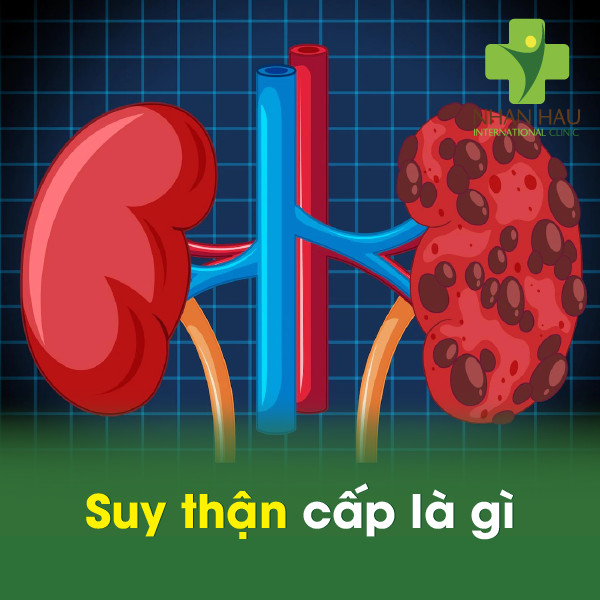 Bệnh suy thận cấp nguy hiểm không 2 Suy thận cấp là gì