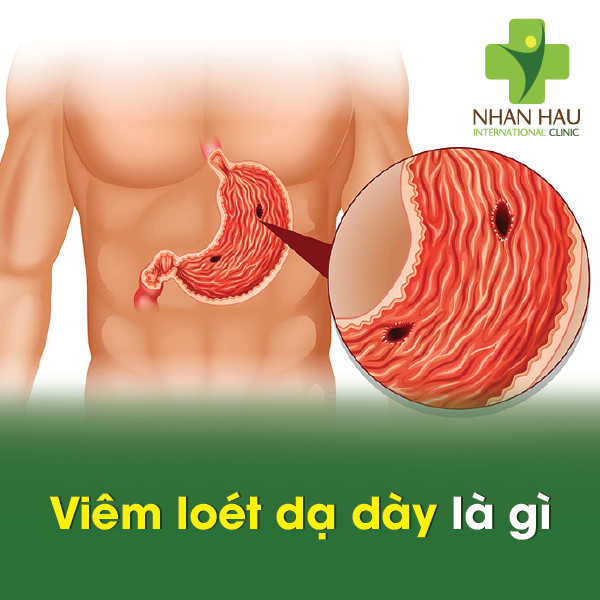 Viêm loét dạ dày và những điều nên lưu ý 2 Viêm loét dạ dày là gì