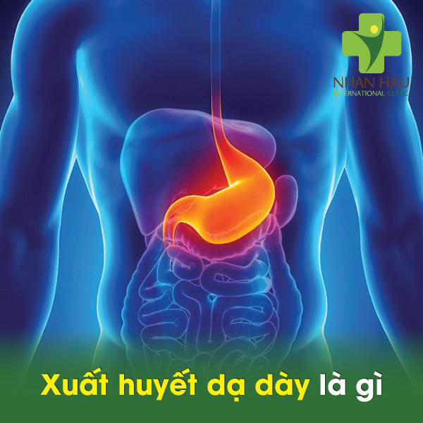 Sự nguy hiểm tiềm ẩn về việc xuất huyết dạ dày 2 Xuất huyết dạ dày là gì