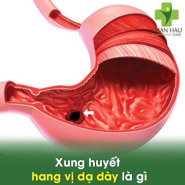 Xung huyết hang vị dạ dày và những nguy cơ gây xung huyết hang vị dạ dày 2 Xung huyết hang vị dạ dày là gì