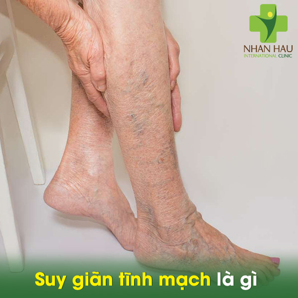 Suy giãn tĩnh mạch và những dấu hiệu lưu ý 1 Suy giãn tĩnh mạch là gì