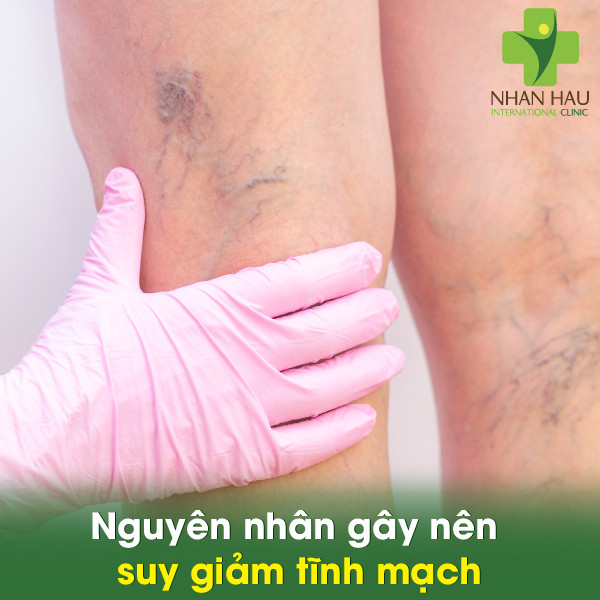 Suy giãn tĩnh mạch và những dấu hiệu lưu ý 2 Nguyên nhân gây nên suy giảm tĩnh mạch