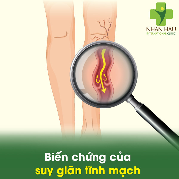 Suy giãn tĩnh mạch và những dấu hiệu lưu ý 4 Biến chứng của suy giãn tĩnh mạch