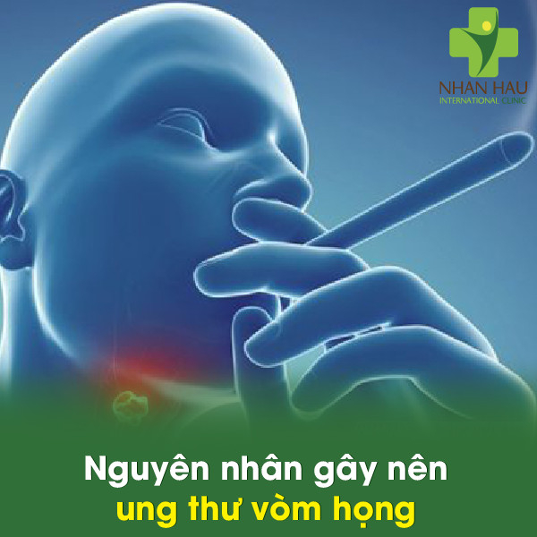 Nguyên nhân gây nên ung thư vòm họng