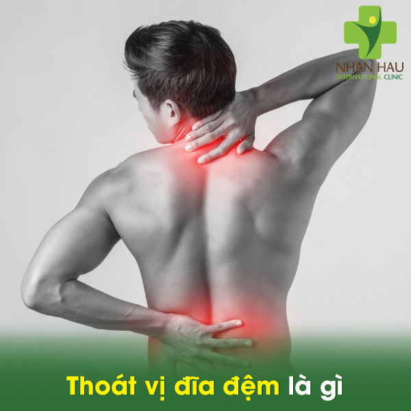 Thoát vị đĩa đệm nên làm thế nào 1 Thoát vị đĩa đệm là gì