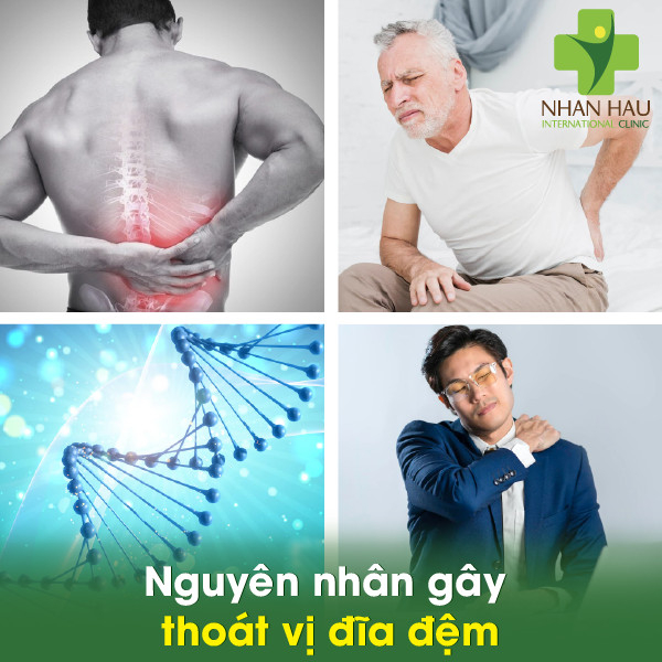 Thoát vị đĩa đệm nên làm thế nào 2 Nguyên nhân gây thoát vị đĩa đệm