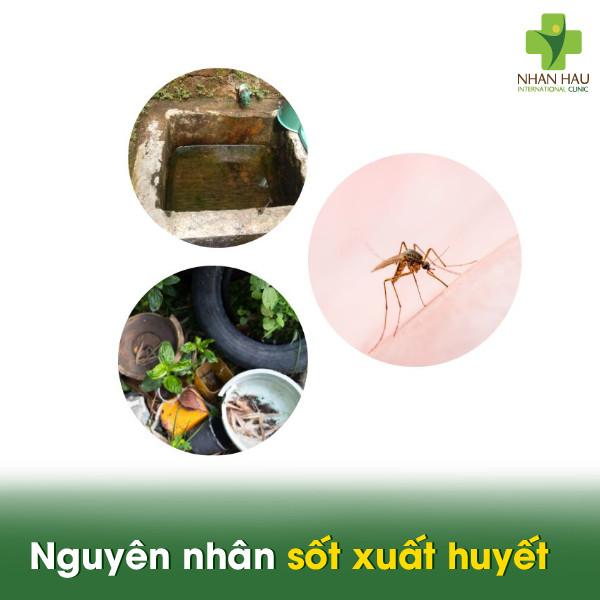 Bệnh sốt xuất huyết: Triệu chứng, nguyên nhân và cách phòng tránh 5 Nguyên nhân gây nên sốt xuất huyết