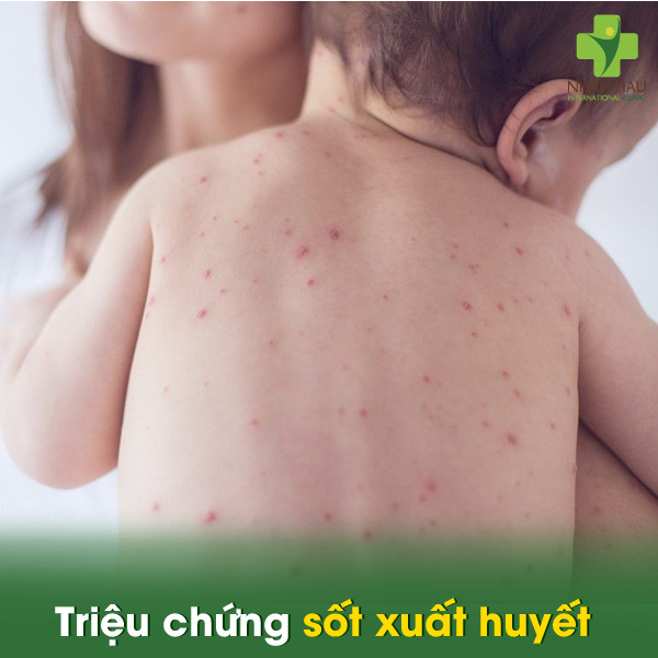 Bệnh sốt xuất huyết: Triệu chứng, nguyên nhân và cách phòng tránh 6 Triệu chứng sốt xuất huyết