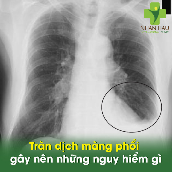 Tràn dịch màng phổi gây nên những nguy hiểm gì? 5 Tràn dịch màng phổi gây nên những nguy hiểm gì