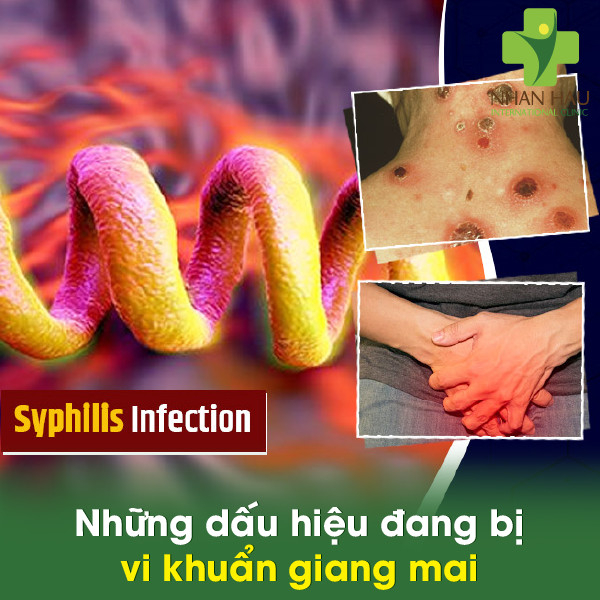 Vi khuẩn giang mai sẽ gây nên những nguy hiểm gì cho cơ thể 3 Những dấu hiệu đang bị vi khuẩn giang mai