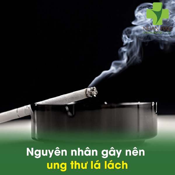 Ung thư lá lách và những điều cần phòng tránh 3 Nguyên nhân gây nên ung thư lá lách