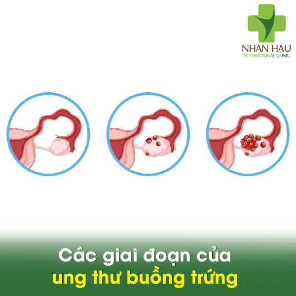 Ung thư buồng trứng và những điều lưu ý cần phòng tránh 5 Các giai đoạn của ung thư buồng trứng