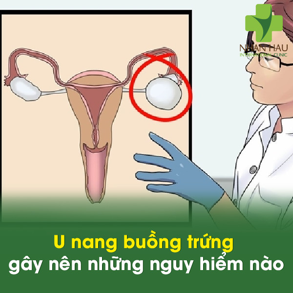 U nang buồng trứng gây nên những nguy hiểm nào 5 U nang buồng trứng gây nên những nguy hiểm nào