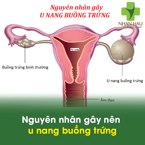 U nang buồng trứng gây nên những nguy hiểm nào 3 Nguyên nhân gây nên u nang buồng trứng