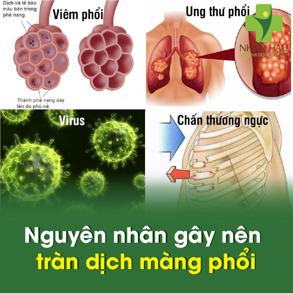 Tràn dịch màng phổi gây nên những nguy hiểm gì? 3 Nguyên nhân gây nên tràn dịch màng phổi