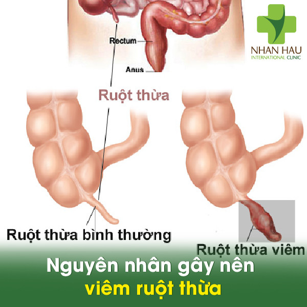 Viêm ruột thừa gây nên những nguy hiểm nào cho cơ thể 2 Nguyên nhân gây nên viêm ruột thừa