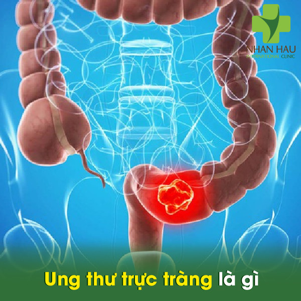 Ung thư trực tràng nên lưu ý những vấn đề gì 2 Ung thư trực tràng là gì