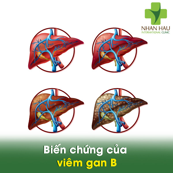 Viêm gan B nếu không chữa trị sẽ gây nên những biến chứng gì 5 Biến chứng của viêm gan B