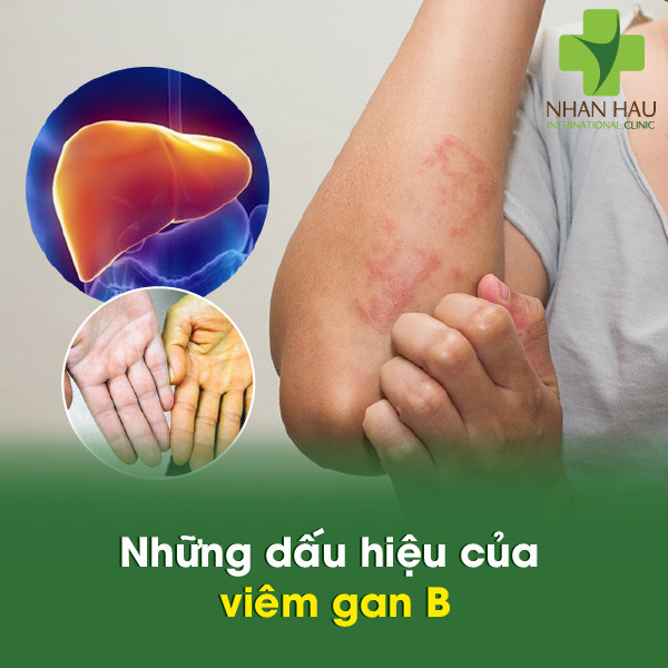 Viêm gan B nếu không chữa trị sẽ gây nên những biến chứng gì 4 Những dấu hiệu của viêm gan B