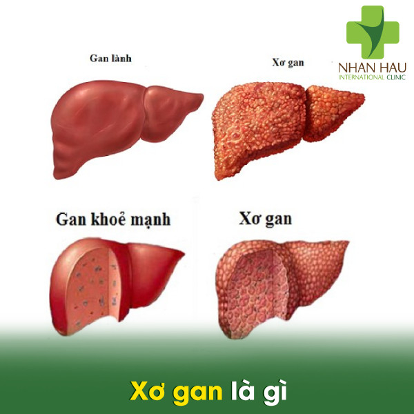 Xơ gan nếu không chữa trị thì sẽ có di chứng gì 2 Xơ gan là gì