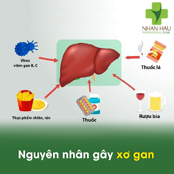 Xơ gan nếu không chữa trị thì sẽ có di chứng gì 3 Nguyên nhân gây xơ gan