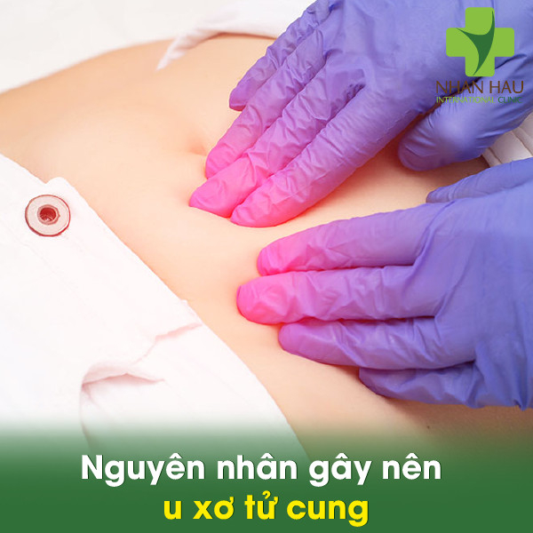 U xơ tử cung và những biến chứng nặng nề 3 Nguyên nhân gây nên u xơ tử cung