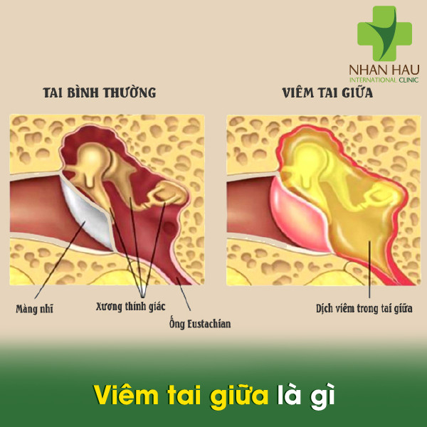 Viêm tai giữa và nguyên nhân gây nên bệnh viêm tai giữa 2 Viêm tai giữa là gì