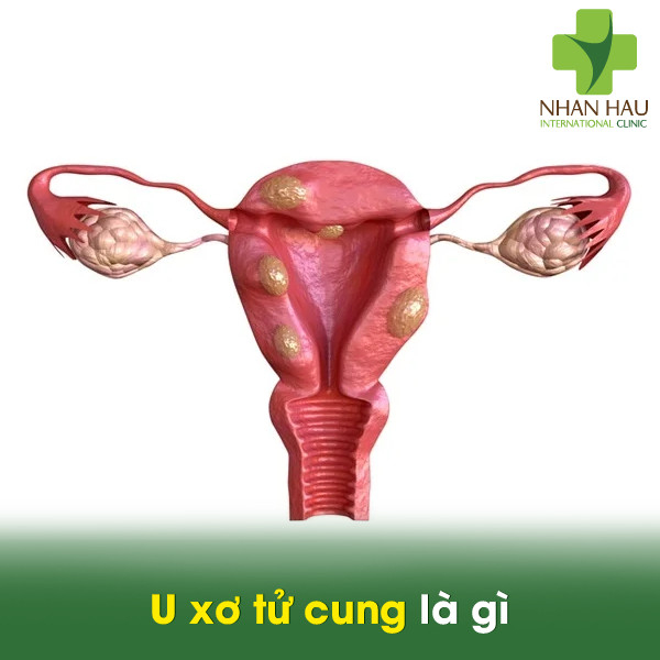 U xơ tử cung và những biến chứng nặng nề 2 U xơ tử cung là gì