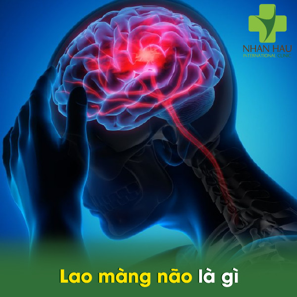 Lao màng não và những dấu hiệu của lao màng não 2 Lao màng não là gì