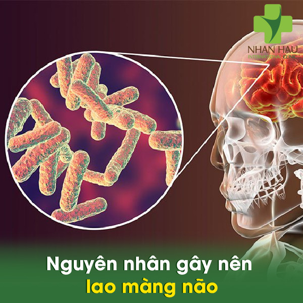 Lao màng não và những dấu hiệu của lao màng não 3 Nguyên nhân gây nên lao màng não