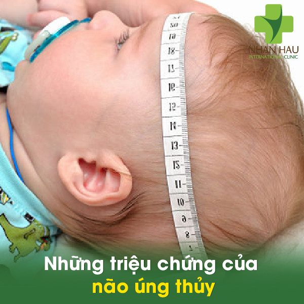 Não úng thủy và những điều lưu ý ở bệnh não úng thủy 4 Những triệu chứng của não úng thủy