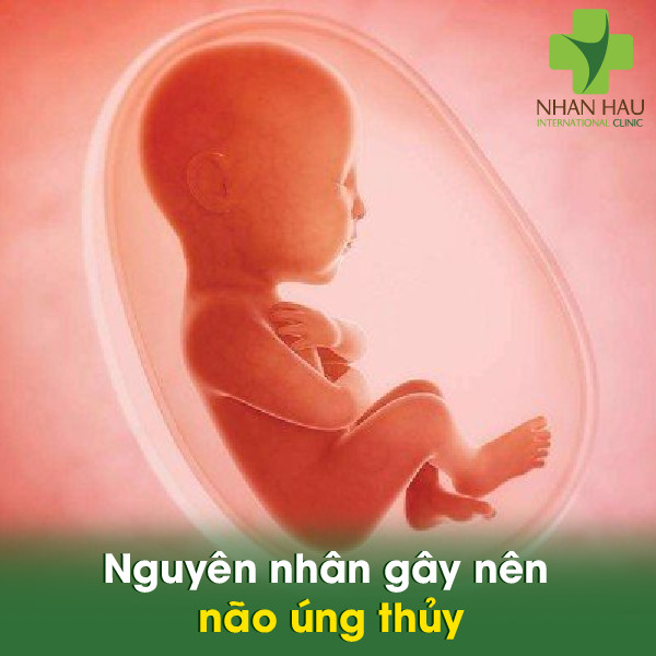 Não úng thủy và những điều lưu ý ở bệnh não úng thủy 3 Nguyên nhân gây nên não úng thủy