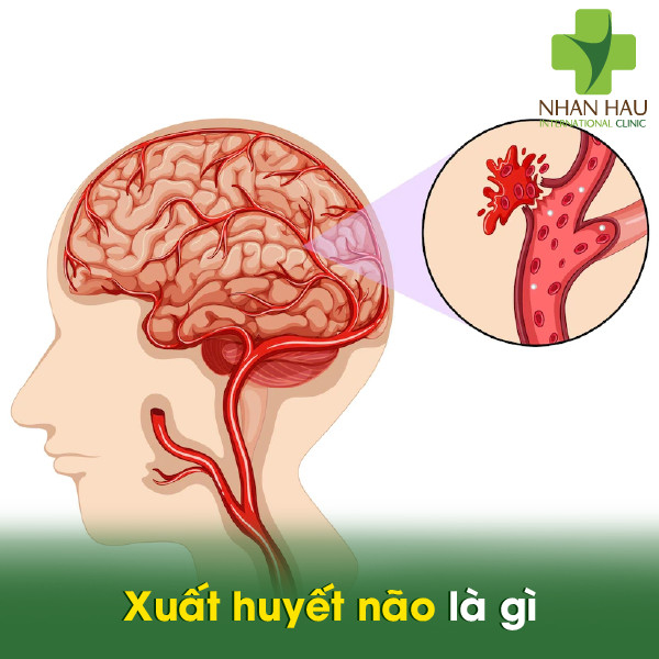 Xuất huyết não gây biến chứng gì cho cơ thể 2 Xuất huyết não là gì