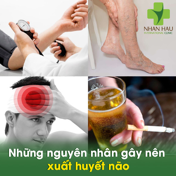 Xuất huyết não gây biến chứng gì cho cơ thể 3 Những nguyên nhân gây nên xuất huyết não