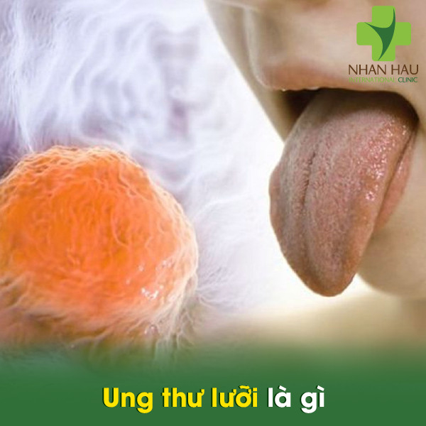 Ung thư lưỡi và những nguyên nhân nên lưu ý 2 Ung thư lưỡi là gì