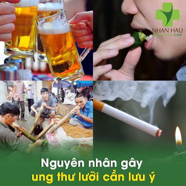 Ung thư lưỡi và những nguyên nhân nên lưu ý 3 Nguyên nhân gây ung thư lưỡi cần lưu ý