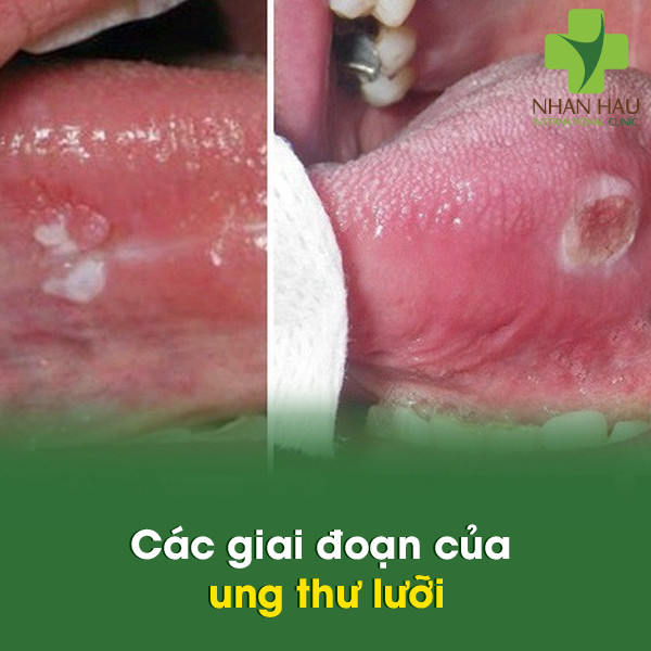 Ung thư lưỡi và những nguyên nhân nên lưu ý 5 Các giai đoạn của ung thư lưỡi