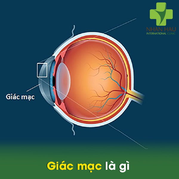 Viêm giác mạc và cách khắc phục 1 Giác mạc là gì
