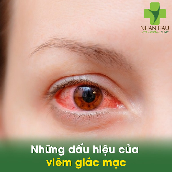 Viêm giác mạc và cách khắc phục 4 Những dấu hiệu của viêm giác mạc